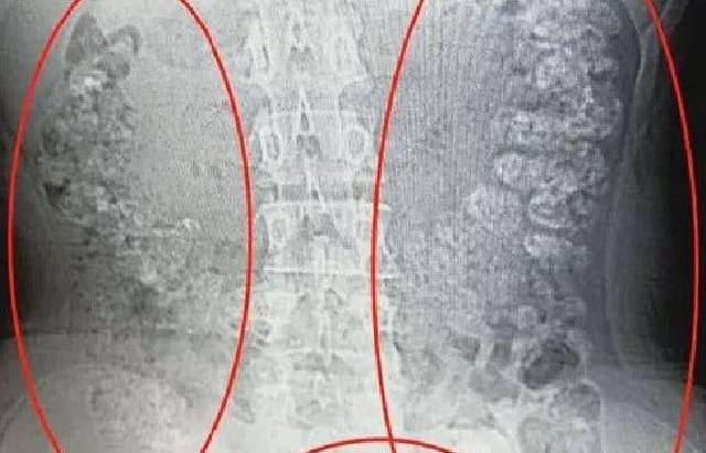 Hasil CT Scan yang menunjukkan gelembung teh susu mutiara yang ditemukan dalam perut gadis di Cina. (Foto: Shaoxing)