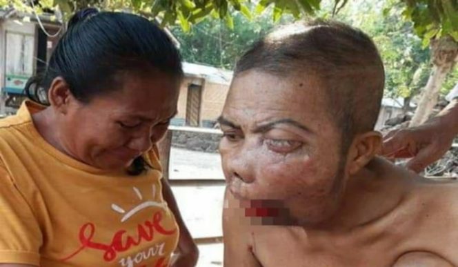 					Tumor mulut yang dialami Sukirman hingga sering mengeluarkan darah. (BERITA.NEWS). 