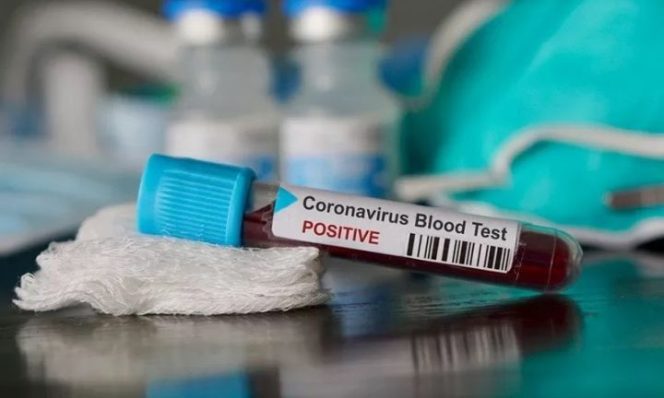 					ILUSTRASI - Sample darah yang terindikasi positif virus corona. ANTARA/Shutterstock/am.